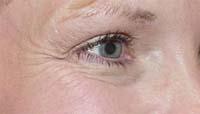 Botox Behandlung Praxis Dr. Kai Rezai