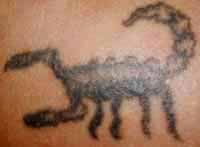 Tattoo Entfernung