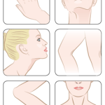 Fadenlifting