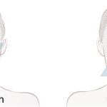 Fadenlifting