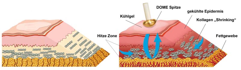 Radiage Methode