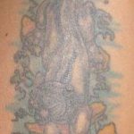 Tattoo Entfernung