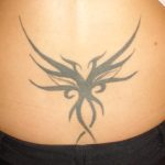 Tattoo Entfernung