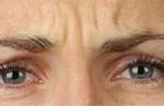 Botox Behandlung Praxis Dr. Kai Rezai