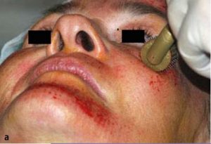 Micro Needling