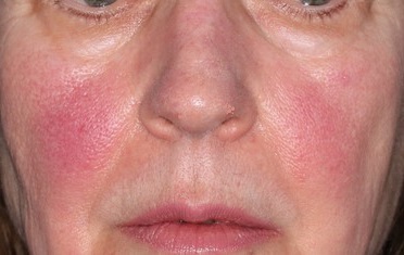 Rosacea